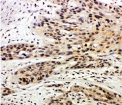 IHC-P: Caspase-14 antibody testing of human esophagus squama cancer tissue