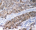 IHC-P: Stefin B antibody testing of human lung cancer tissue
