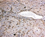 IHC-P: Gelsolin antibody testing of human lung cancer tissue. HIER: steamed with pH6 citrate buffer.