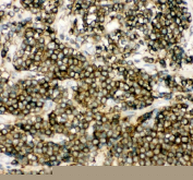 IHC staining of FFPE human lung cancer tissue with NFKB1 antibody. HIER: boil tissue sections in pH8 EDTA for 20 min and allow to cool before testing.