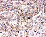 IHC-P: SMAD1 antibody testing of human lung cancer tissue