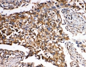 IHC-P: SMAD5 antibody testing of human lung cancer tissue