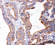 IHC-P: SMAD5 antibody testing of human intestine cancer tissue