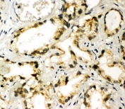 IHC-P: TBK1 antibody testing of human prostate cancer tissue. HIER: steamed with pH6 citrate buffer.
