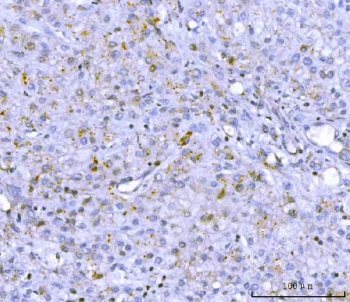 IHC staining of FFPE human liver cancer tissue with PCSK9 antibody. HIER: boil tissue sections in pH8 EDTA for 20 min and allow to cool before testing.~