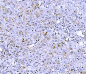 IHC staining of FFPE human liver cancer tissue with PCSK9 antibody. HIER: boil tissue sections in pH8 EDTA for 20 min and allow to cool before testing.