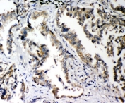 IHC-P: PLK2 antibody testing of human lung cancer tissue. HIER: steam section in pH6 citrate buffer for 20 min and allow to cool prior to staining.
