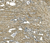 IHC staining of FFPE human gastric carcinoma tissue with COL1A1 antibody. HIER: boil tissue sections in pH8 EDTA for 20 min and allow to cool before testing.