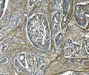 IHC staining of FFPE human colon adenocarcinoma tissue with COL1A1 antibody. HIER: boil tissue sections in pH8 EDTA for 20 min and allow to cool before testing.