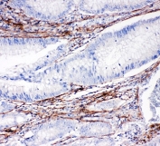 IHC-P: Collagen 1 antibody testing of human intestine cancer tissue. HIER: boil tissue sections in pH6, 10mM citrate buffer, for 10-20 min and allow to cool before testing.
