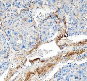 IHC staining of FFPE human liver cancer tissue with Collagen 1 antibody. HIER: boil tissue sections in pH8 EDTA for 20 min and allow to cool before testing.