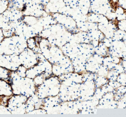 IHC staining of FFPE human renal cell carcinoma tissue with Collagen 1 antibody, HRP secondary and DAB substrate. HIER: boil tissue sections in pH8 EDTA for 20 min and allow to cool before testing.