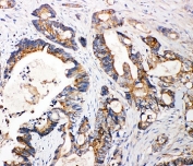 IHC-P: FGFR3 antibody testing of human intestine cancer tissue