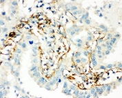 IHC-P: Transglutaminase 2 antibody testing of human lung cancer tissue