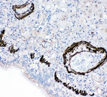 IHC-P: FABP6 antibody testing of human lung cancer tissue~