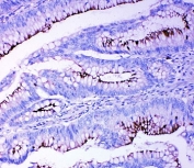 IHC-P: Profilin 2 antibody testing of human intestinal cancer tissue