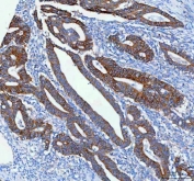 IHC staining of FFPE human colorectal adenocarcinoma tissue with NKCC1 antibody. HIER: boil tissue sections in pH8 EDTA for 20 min and allow to cool before testing.