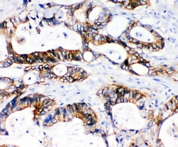 IHC-P: NKCC1 antibody testing of human intestinal cancer tissue