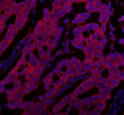 Immunofluorescent staining of FFPE human colon cancer tissue with NKCC1 antibody (red) and DAPI nuclear stain (blue). HIER: steam section in pH8 EDTA buffer for 20 min.
