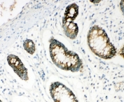 IHC-P: HYAL1 antibody testing of human intestine cancer tissue.