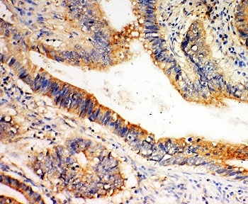 IHC-P: SLC1A4 antibody testing of human intestine cancer tissue