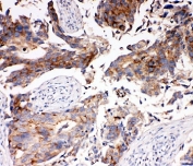 IHC-P: MCT5 antibody testing of human breast cancer tissue