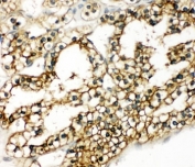 IHC-P: COMT antibody testing of human kidney cancer tissue. HIER: boil tissue sections in pH8 EDTA for 20 min and allow to cool before testing.