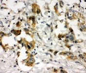 IHC-P: COMT antibody testing of human lung cancer tissue. HIER: boil tissue sections in pH8 EDTA for 20 min and allow to cool before testing.