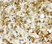 IHC-P: SERPINA3 antibody testing of human liver cancer tissue