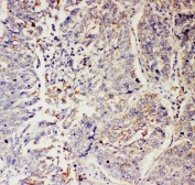 IHC staining of FFPE human lung cancer tissue with SLC9A2 antibody. HIER: boil tissue sections in pH6 citrate buffer for 20 min and allow to cool before testing.