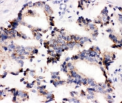IHC-P: IRAK2 antibody testing of human lung cancer tissue