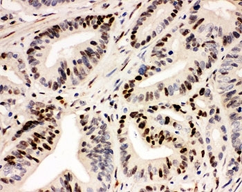IHC-P: IRF1 antibody testing of human intestinal cancer tissue