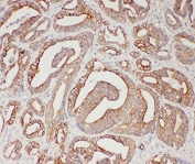 IHC-P: TNFAIP8L3 antibody testing of human intestinal cancer tissue