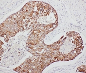 IHC-P: TNFAIP8L3 antibody testing of human breast cancer tissue