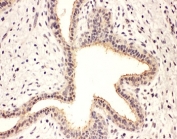 IHC-P: Rab8 antibody testing of human breast cancer tissue