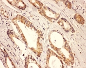 IHC-P: Rab8 antibody testing of human intestine cancer tissue