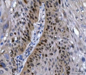 IHC staining of FFPE human laryngeal squamous cell carcinoma tissue with SOX2 antibody. HIER: boil tissue sections in pH8 EDTA for 20 min and allow to cool before testing.