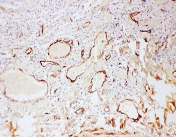IHC-P: Adiponectin antibody testing of human lung cancer tissue. HIER: steamed with pH6 citrate buffer.