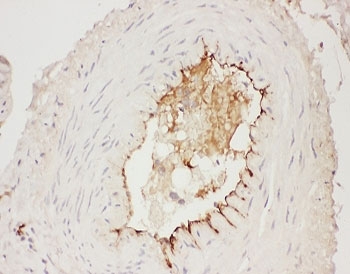 IHC-P: Adiponectin antibody testing of human breast cancer tissue. HIER: steamed with pH6 citrate buffer.
