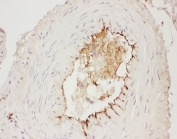 IHC-P: Adiponectin antibody testing of human breast cancer tissue. HIER: steamed with pH6 citrate buffer.
