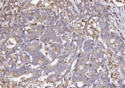 IHC staining of FFPE human colonic adenoma tissue with COX1 antibody. HIER: boil tissue sections in pH8 EDTA for 20 min and allow to cool before testing.