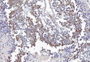 IHC staining of FFPE human lung cancer tissue with COX1 antibody. HIER: boil tissue sections in pH8 EDTA for 20 min and allow to cool before testing.