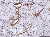 IHC staining of FFPE human breast cancer tissue with COX1 antibody. HIER: boil tissue sections in pH8 EDTA for 20 min and allow to cool before testing.