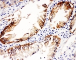 IHC staining of FFPE human intestinal cancer with ITGB4 antibody at 1ug/ml. HIER: boil tissue sections in pH6, 10mM citrate buffer, for 10-20 min and allow to cool before testing.