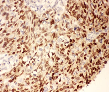 IHC-P: p53 antibody testing of human lung cancer tissue