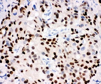 IHC-P: Progesterone Receptor antibody testing of human breast cancer tissue