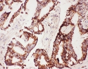 IHC-P: CNTF antibody testing of human lung cancer tissue. HIER: steamed with pH6 citrate buffer.