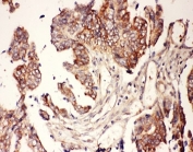 IHC-P: CNTF antibody testing of human intestine cancer tissue. HIER: steamed with pH6 citrate buffer.