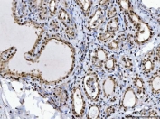 IHC staining of FFPE human thyroid cancer tissue with BRCA1 antibody. HIER: boil tissue sections in pH8 EDTA for 20 min and allow to cool before testing.