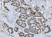 IHC staining of FFPE human colorectal adenocarcinoma tissue with BRCA1 antibody. HIER: boil tissue sections in pH8 EDTA for 20 min and allow to cool before testing.